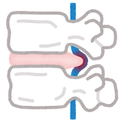椎間板ヘルニアの本当の原因とは？｜福島県二本松市で整体による根本改善を目指すなら